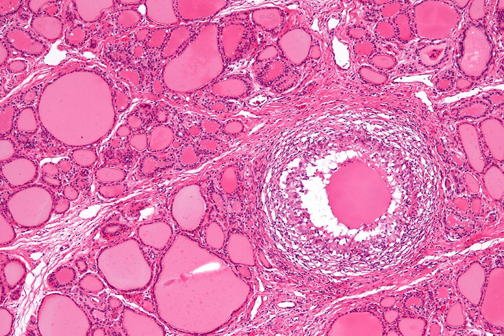 Subakutni tiroiditis